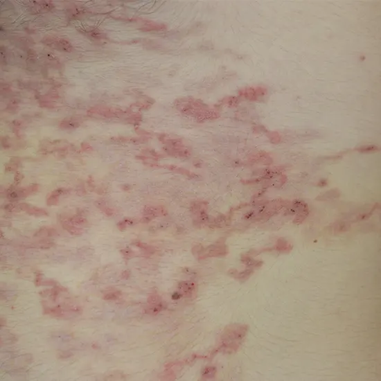 Cutaneous Larva Migrans (CLM)